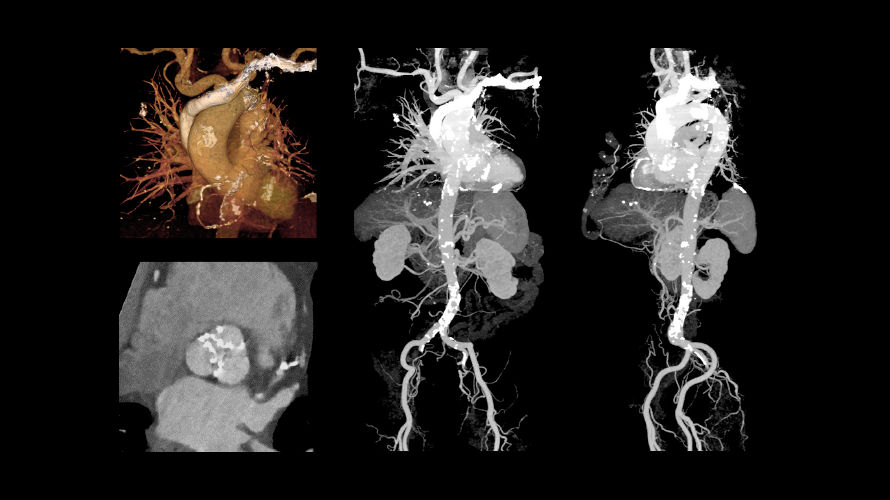 revolution cardiac5