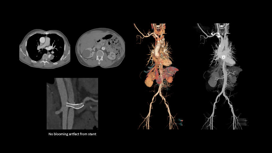 revolution vascular1