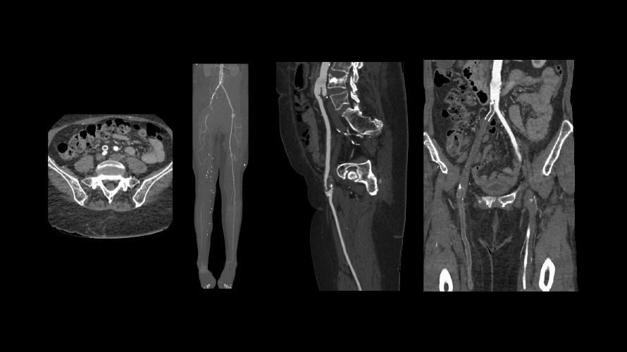 revolution vascular2
