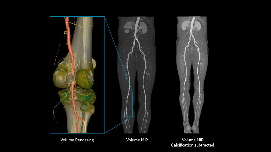 revolution vascular3