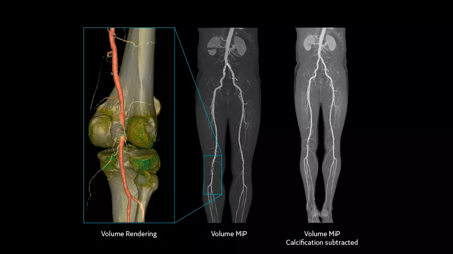 revolution vascular3