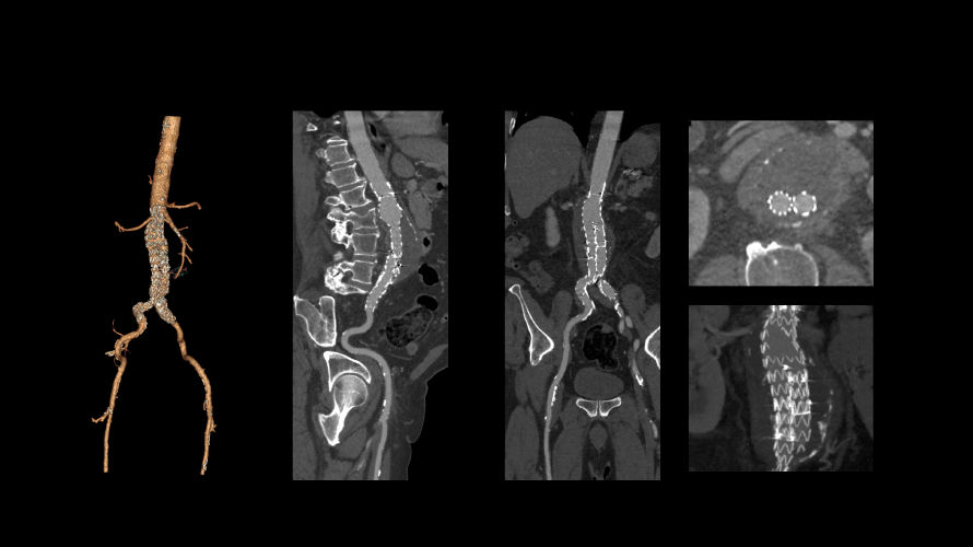 revolution vascular4