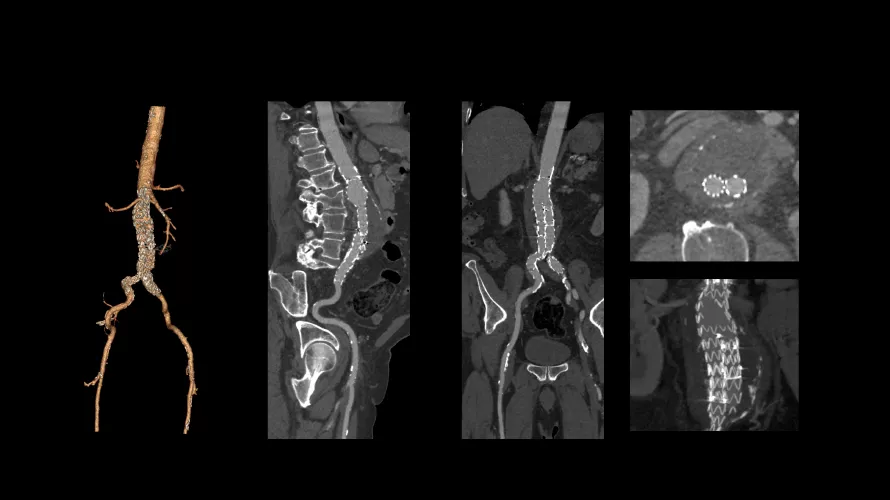 revolution vascular4