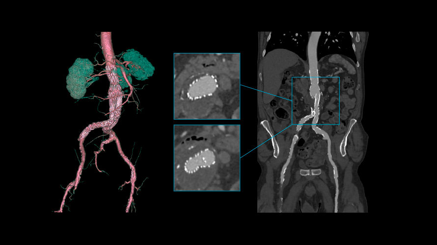 revolution vascular5