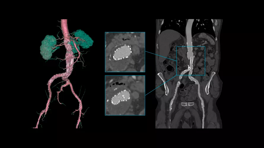 revolution vascular5