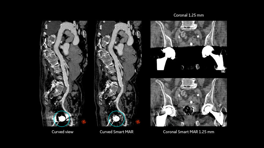 revolution vascular6