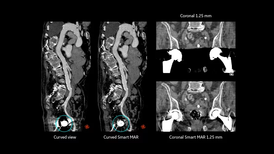 revolution vascular6