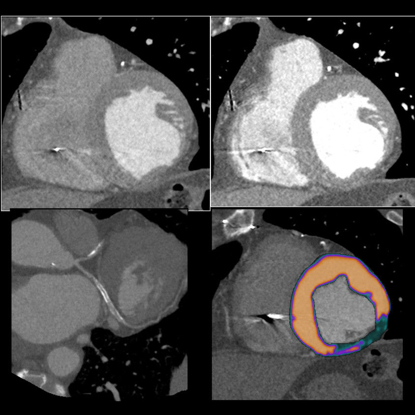 revolutionctclinicalimagescardiacgehcrevolutionctcardiaccinicalreststress2