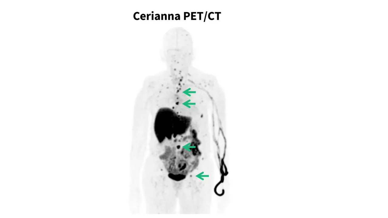Cerianna PET/CT