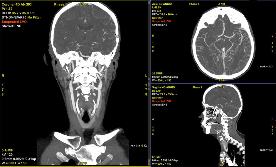 S-Curve-FastStroke-with-StrokeSens-02