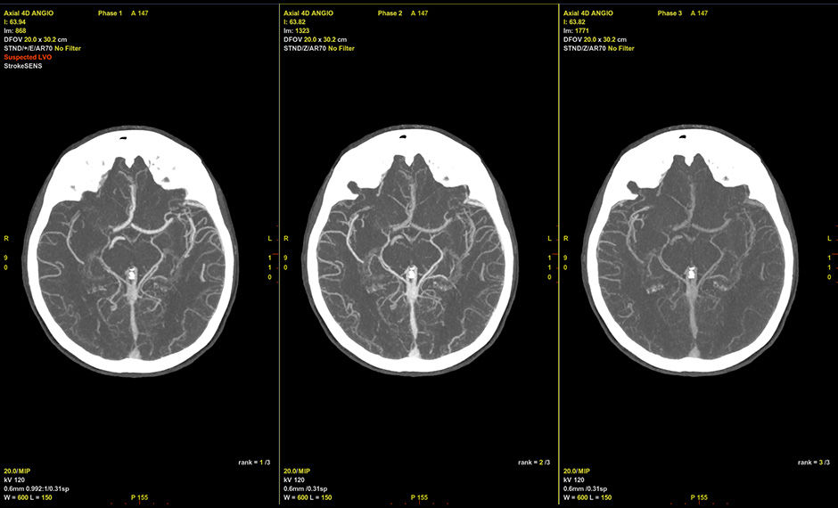 S-Curve-FastStroke-with-StrokeSens-03