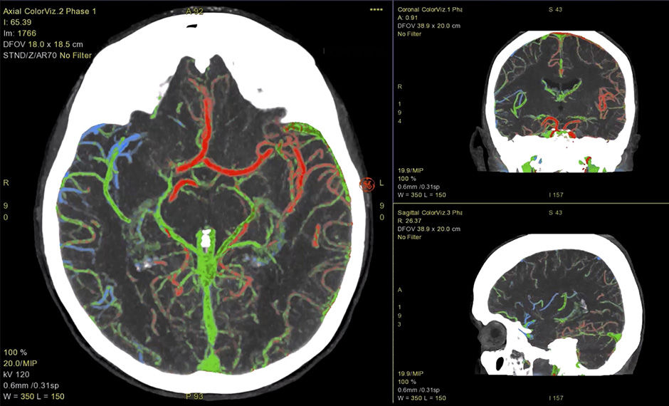 S-Curve-FastStroke-with-StrokeSens-05