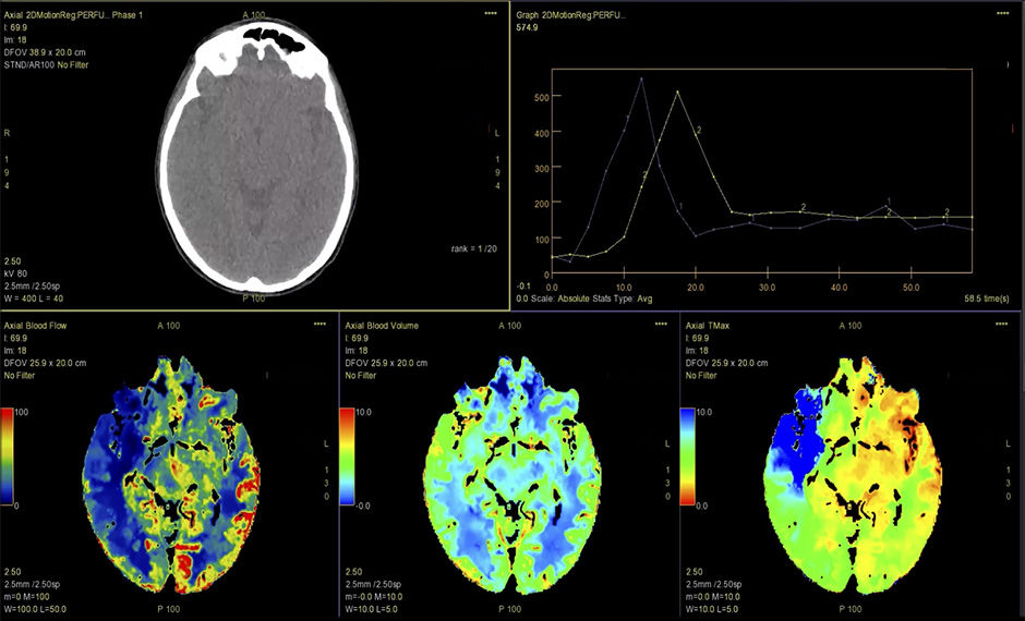 S-Curve-FastStroke-with-StrokeSens-06