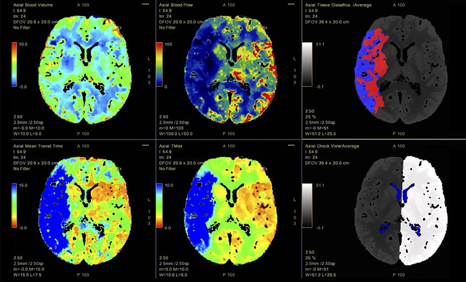 S-Curve-FastStroke-with-StrokeSens-07