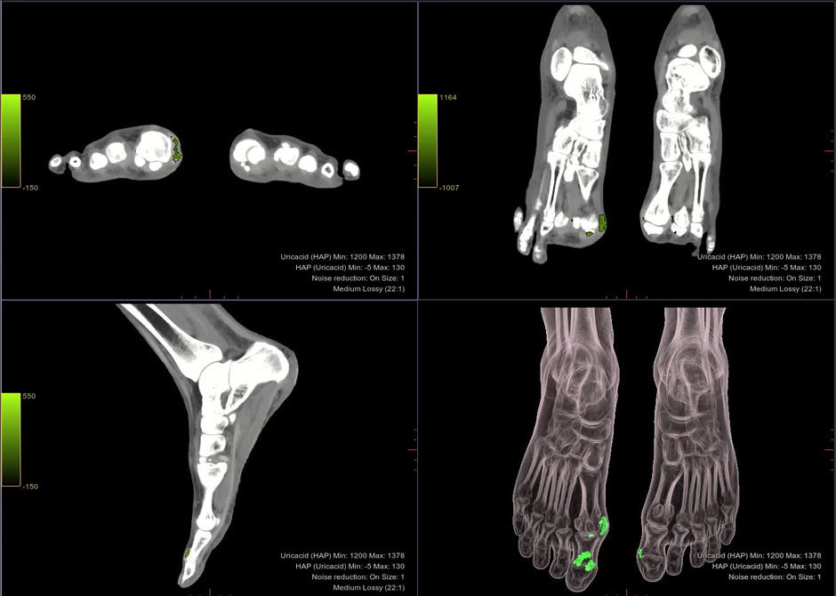 S-Curve-GSI-Gout-Protocol