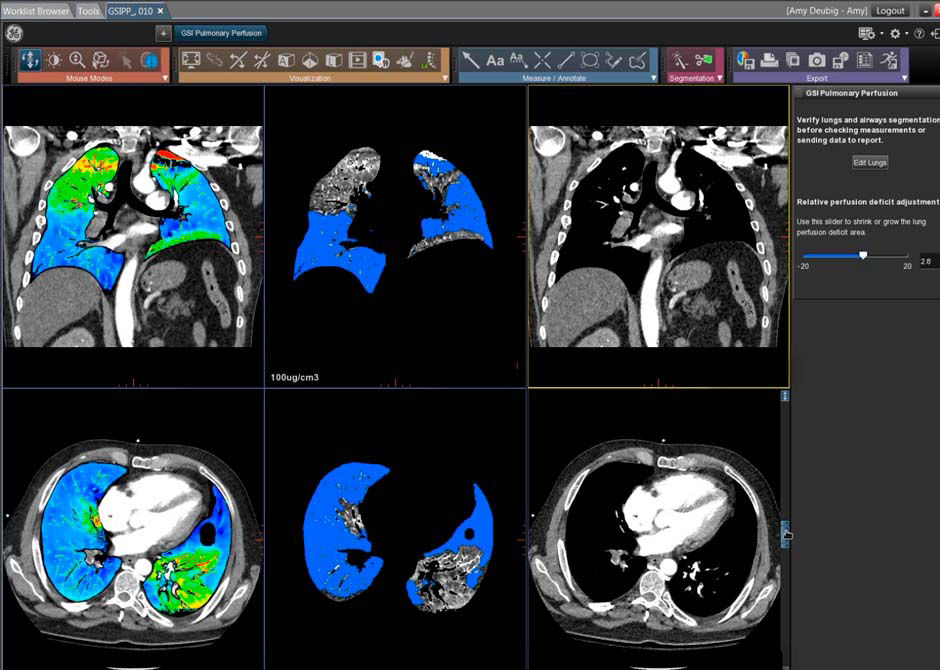 S-Curve-GSI-Pulmonary-Perfusion