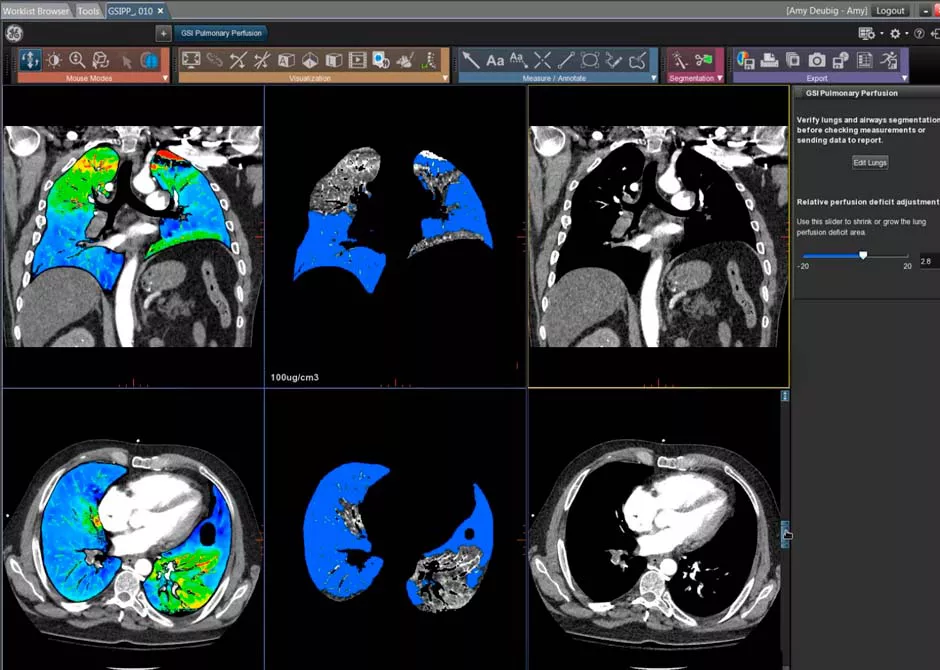S-Curve-GSI-Pulmonary-Perfusion
