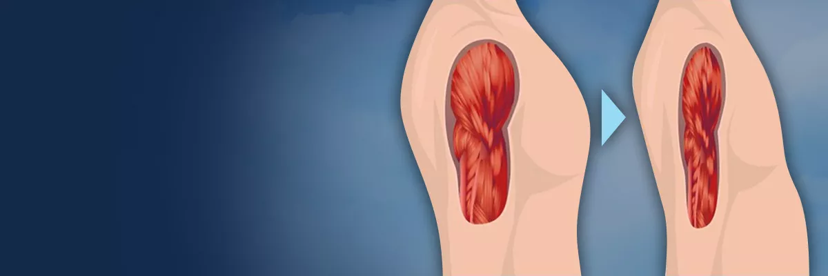 sarcopenia-banner