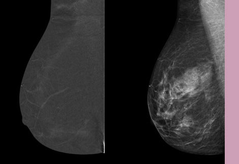 SenoBright HD?-Exceptional breast cancer detection
