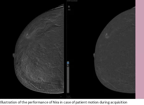 SenoBright HD?-Nira image quality improvements