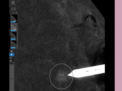 Serena-Bright-Scurve-1-See-and-biopsy-what-matters