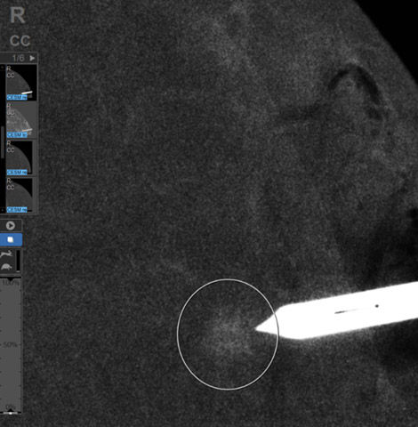 Why CESM-biopsy, why not MRI-biopsy