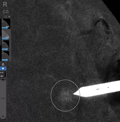 Why CESM-biopsy, why not MRI-biopsy
