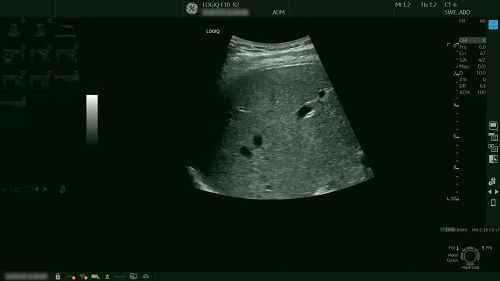 Shear wave elastography