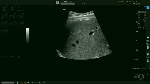 Shear wave elastography