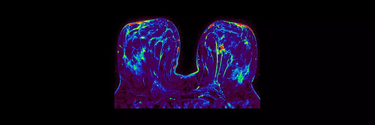 signa-architect-clinical-images-oncoworks-fspgr-ax-dynamic-thumbnail