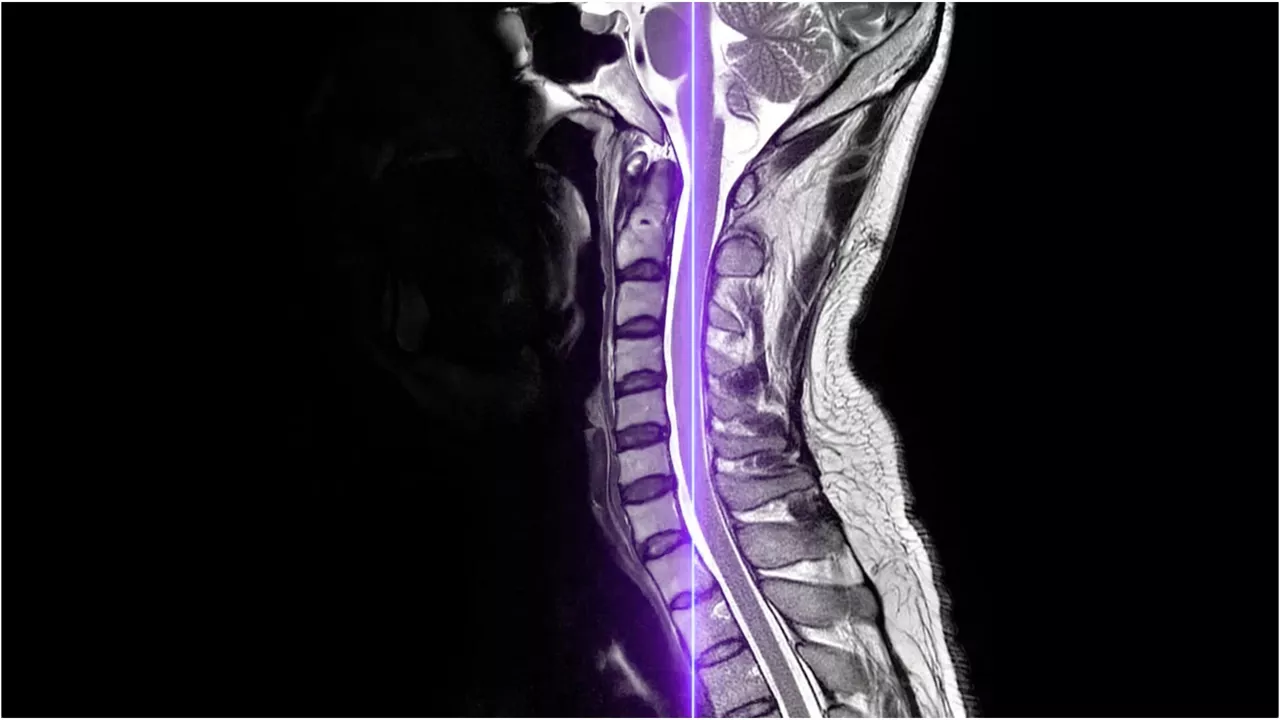 Imagen de AIR Recon DL de SIGNA Continuum para IRM de anterior generación