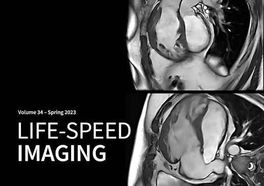 signa-pulse-ai-and-smart-coil-technologies-feature-cards-half-width01-V2