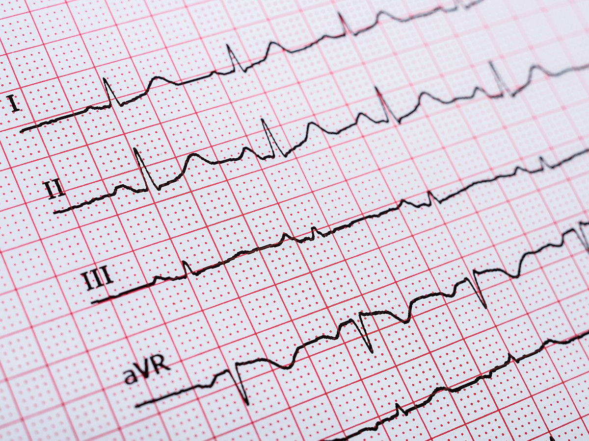 sinus-heart-rhythm-on-el