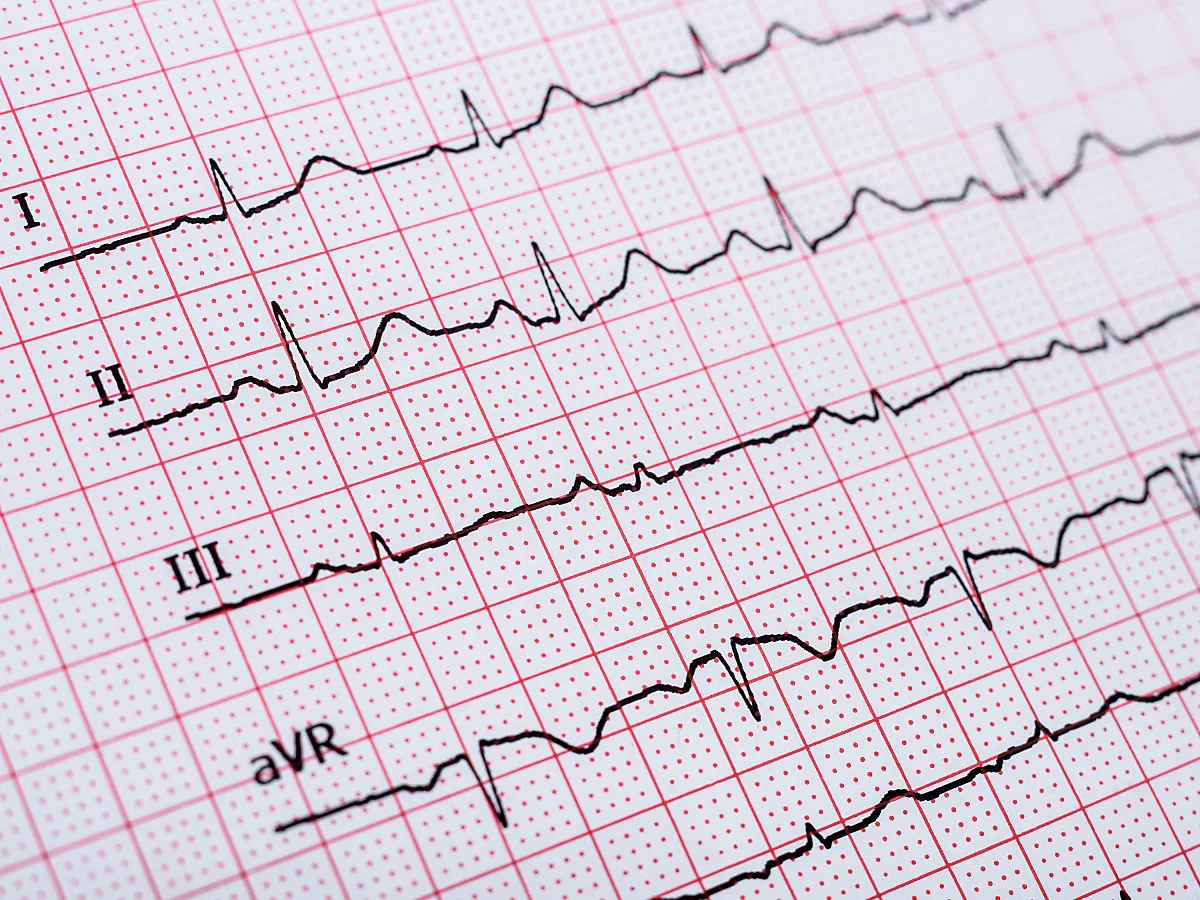 sinus-heart-rhythm-on-el