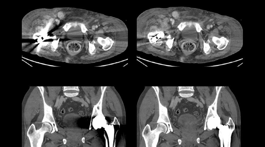 Smart-MAR-for-single-energy-Full-Size