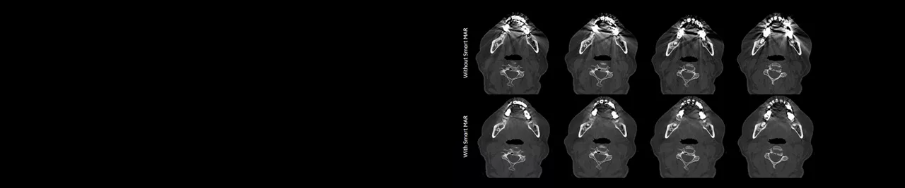 Smart MAR : Goodbye metal artefacts
