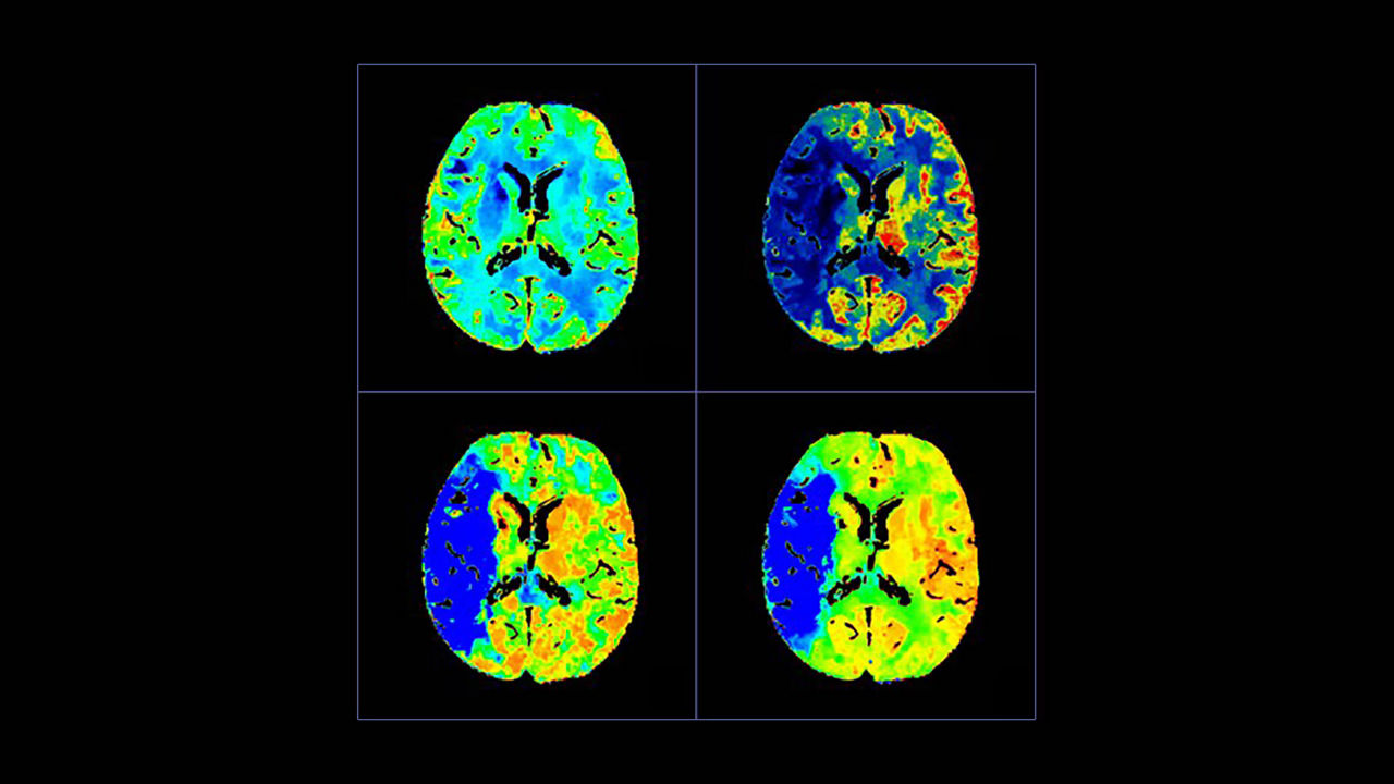 <p>CT Perfusion 4D Neuro</p>
