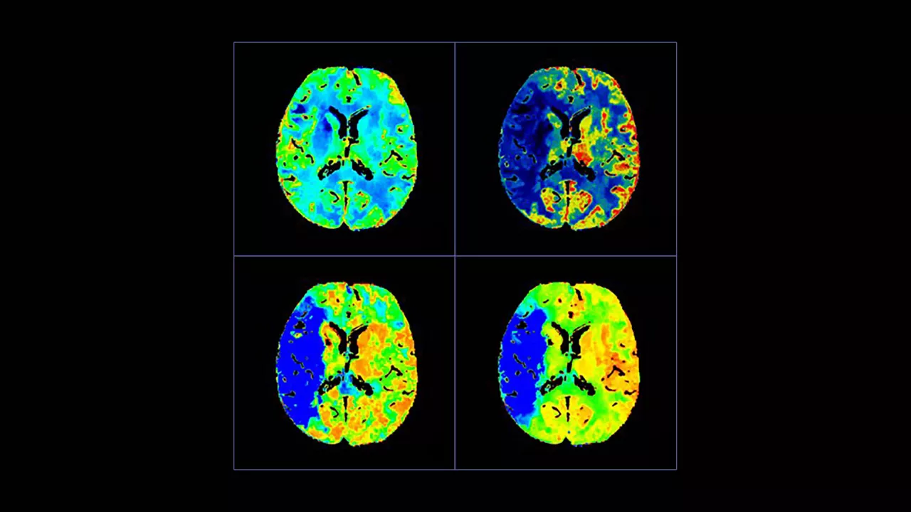 <p>CT Perfusion 4D Neuro</p>
