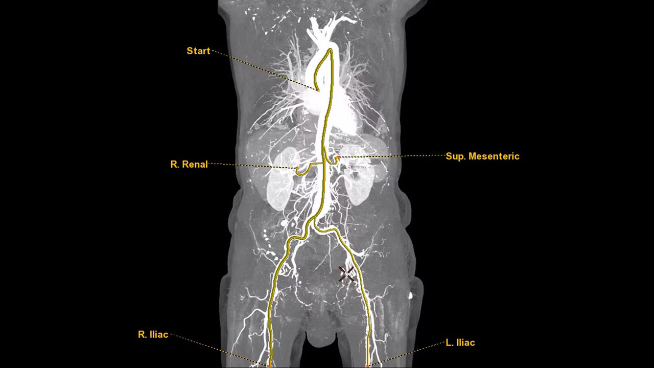 <p>VesselIQ Xpress with AutoBone Xpress</p>
