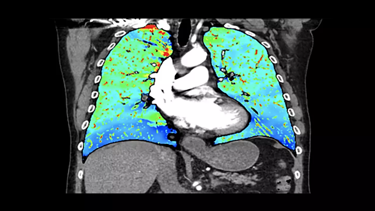 <p>Thoracic VCAR with GSI Pulmonary Perfusion</p>
