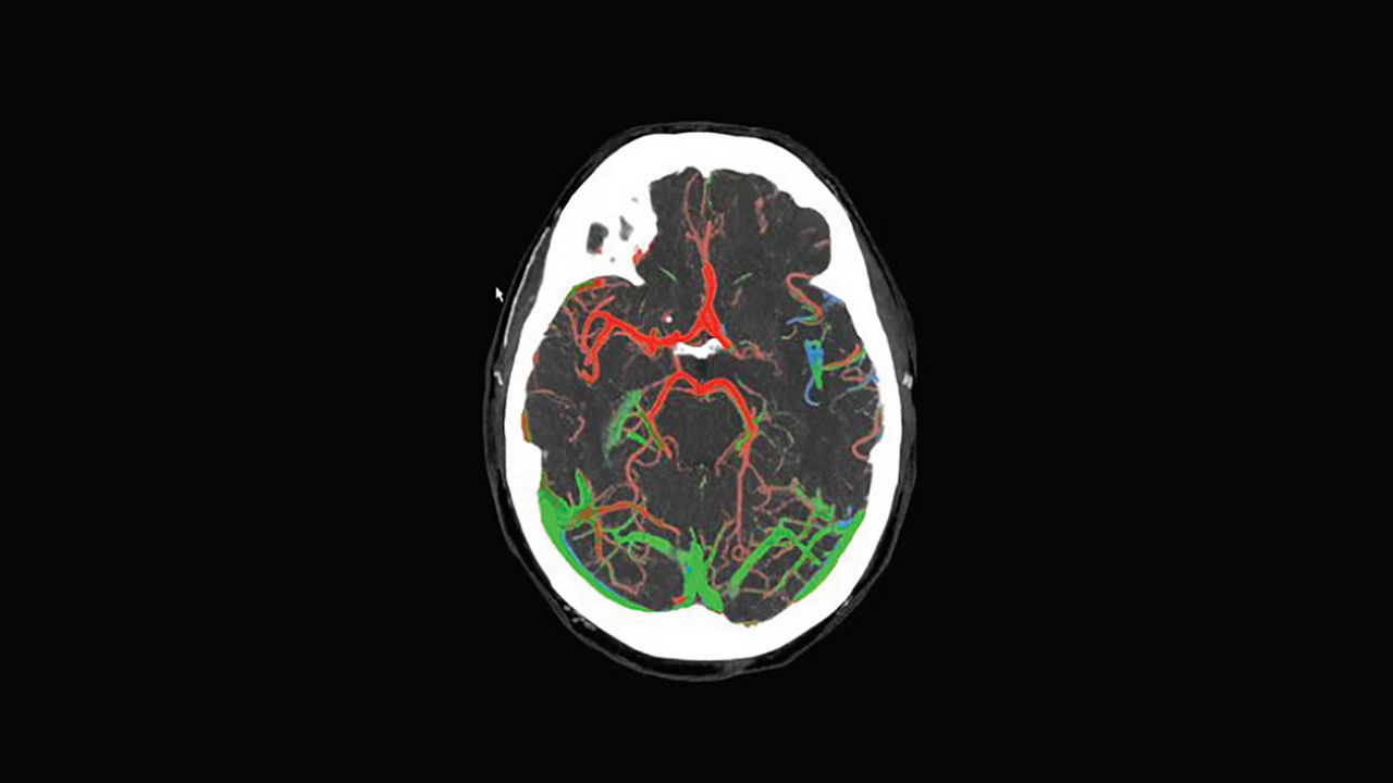 <p>FastStroke with StrokeSENS<sup>3</sup></p>
