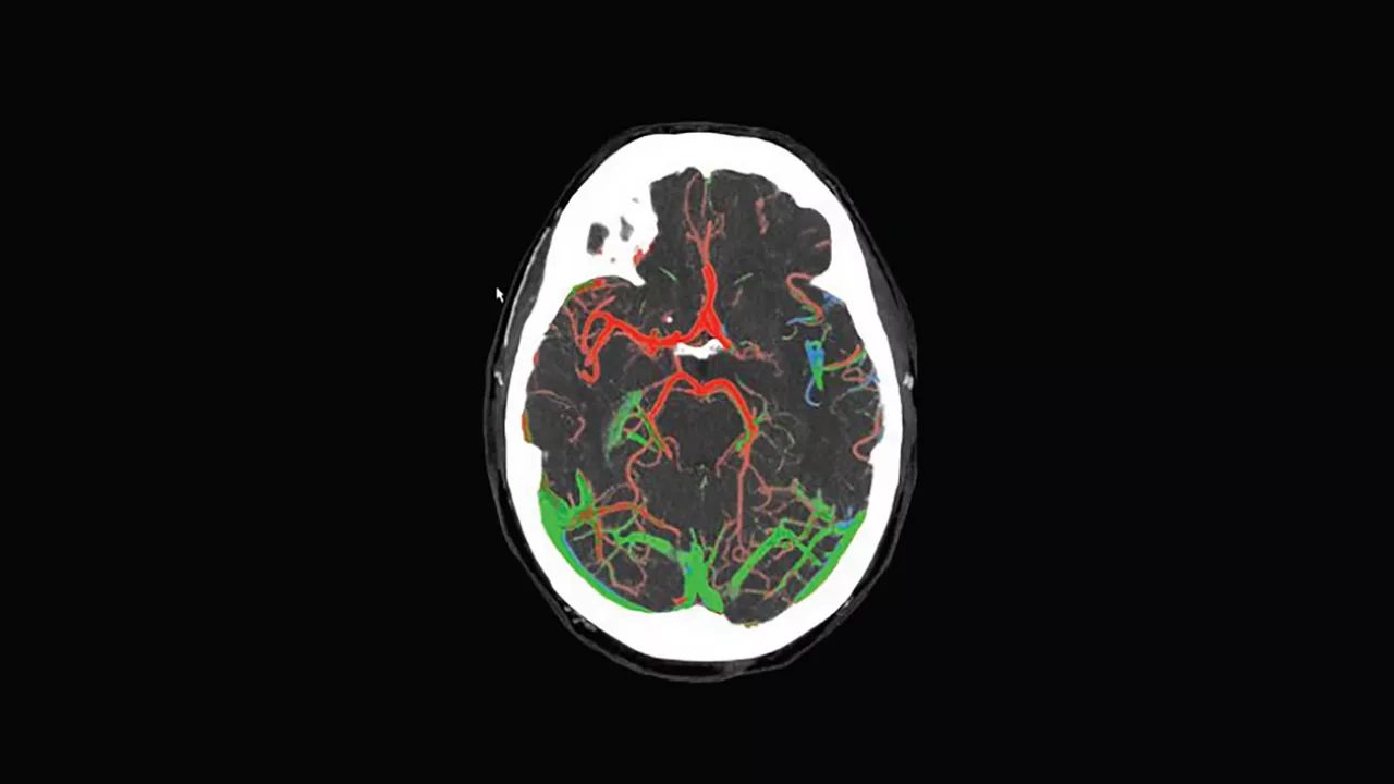 <p>FastStroke with StrokeSENS<sup>3</sup></p>
