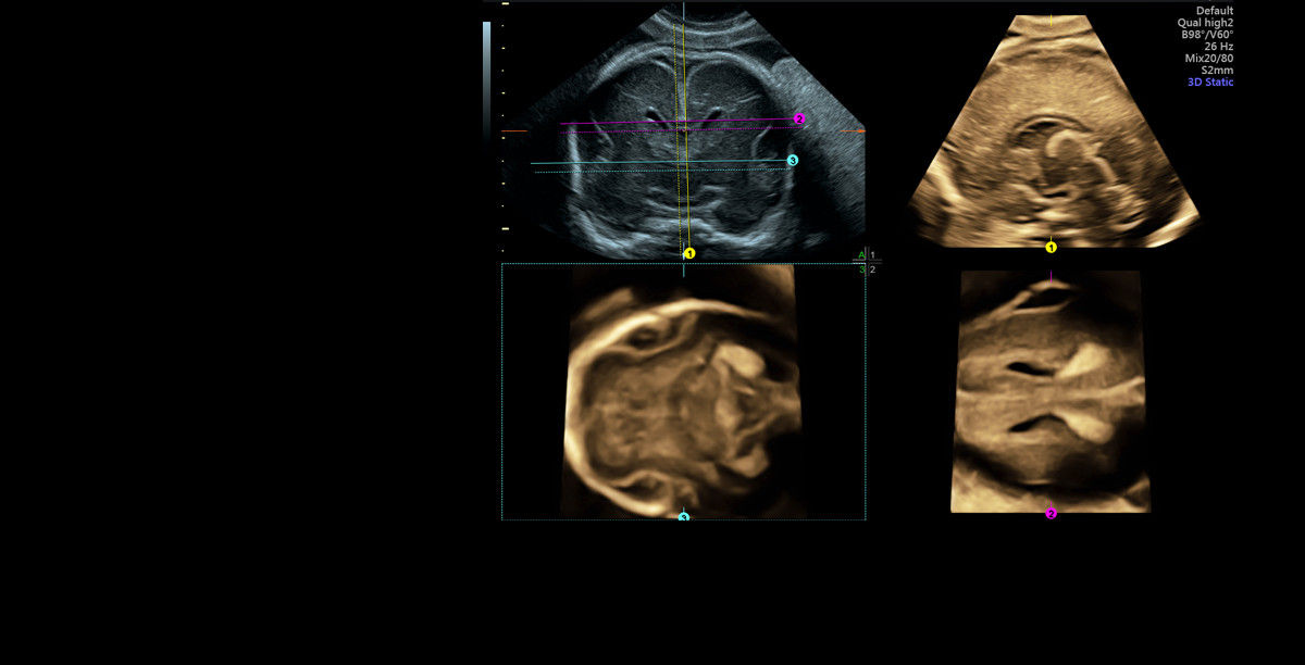 son family-voluson e10-probes-gehc-voluson-e10-high-utilised_fetal_brain_demonstration_jpg