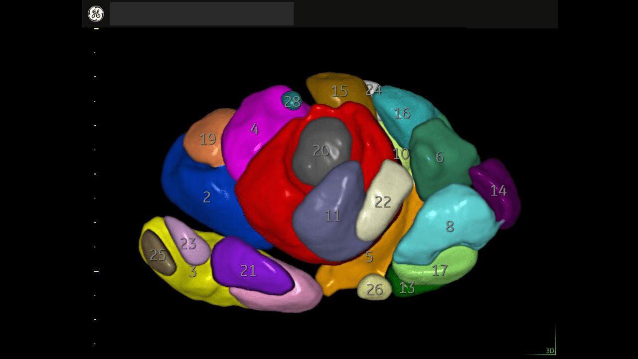 sono-avc-follicle-with-auto-caliper-ci-en