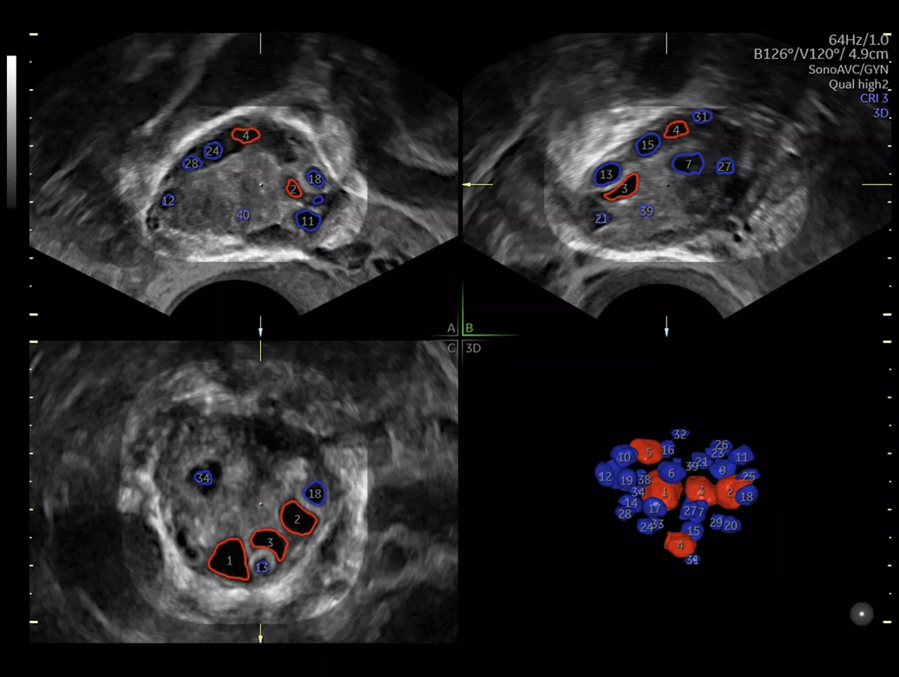 sonoavcfollicle-sonoavcantral-ci-en