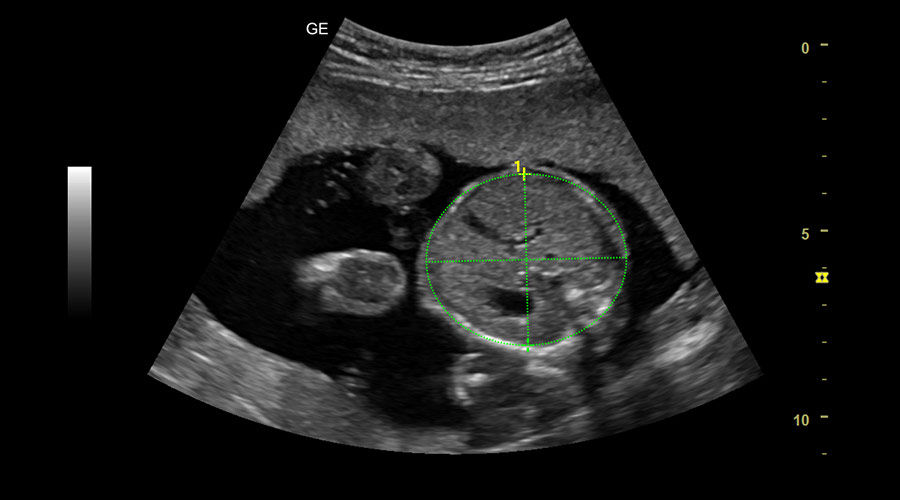 sonobiometry