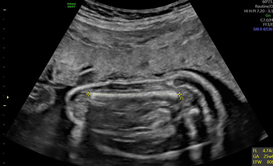 GE Healthcare SonoBiometry Technology