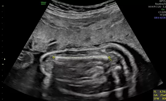 GE Healthcare SonoBiometry Technology