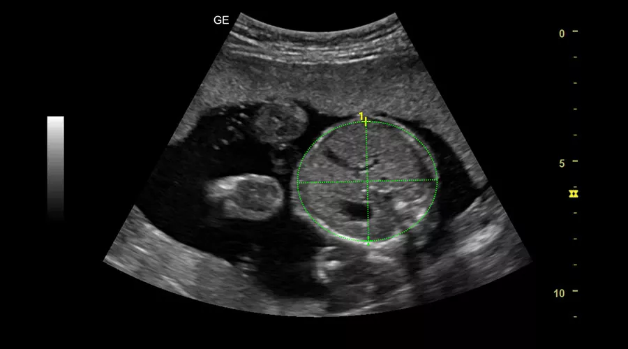 sonobiometry