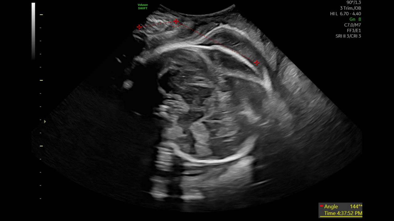 sonold-angle-of-progression-voluson-swift-image-ci-en